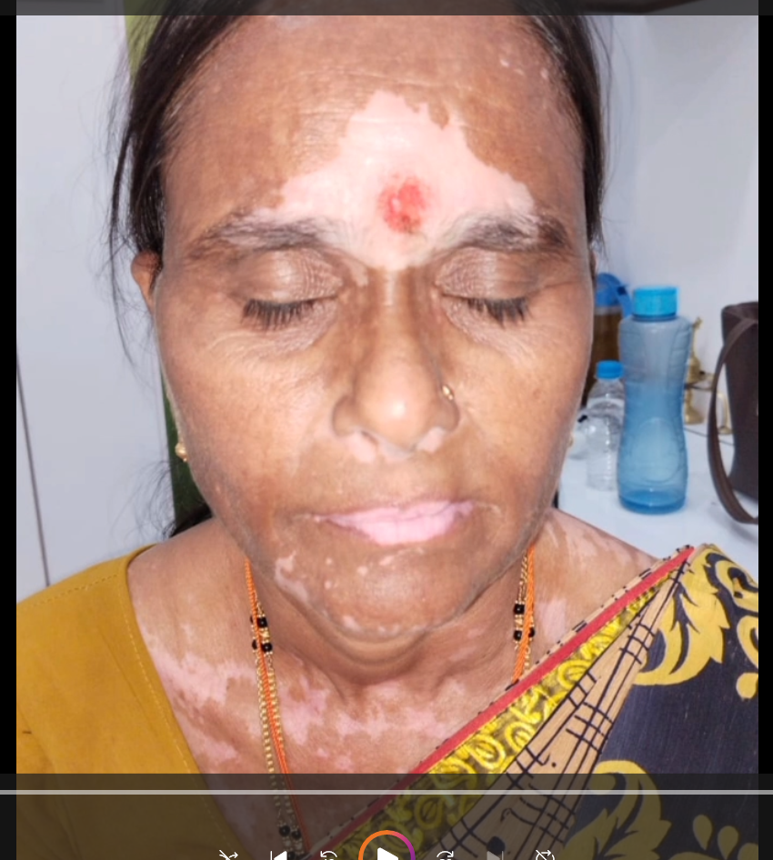 Vitiligo patient testimonial – Meena, 28, showing visible improvement after treatment