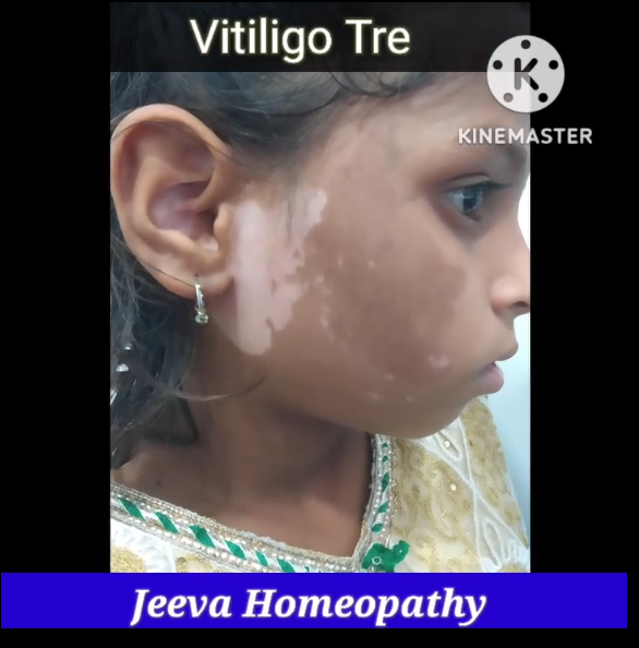 Vitiligo patient testimonial – Shalini, 24, facial vitiligo improvement